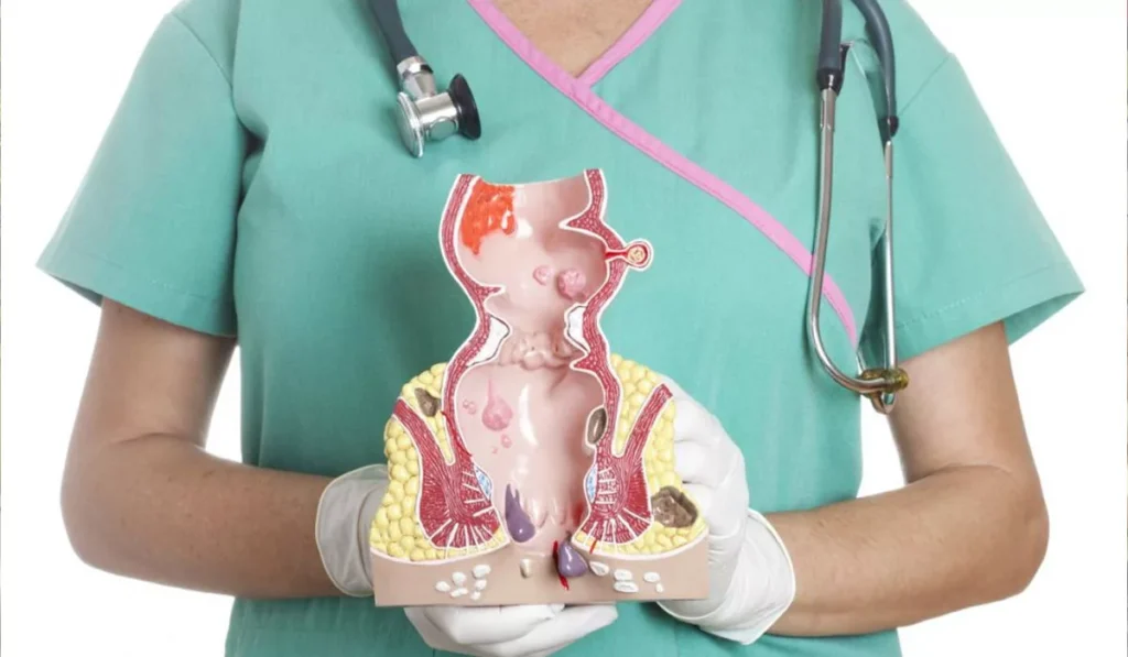 Лікування проктологічних захворювань