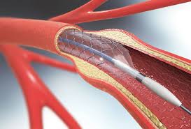 У Франківську планове стентування з 2026 року — держава оплачує процедури